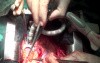 OPCAB - Off Pump Coronary Artery Bypass Grafting - Male Patient