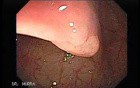 Flat Adenoma (1 of 3)