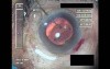Cataract Surgery IV - Part 4