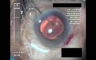 Cataract Surgery IV - Part 4