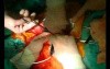 Open Right Hemicolectomy – Technical Principles - Operation No 2 - Part 2