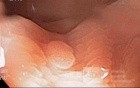 Hyperplastic polyp with lymphoid follicle