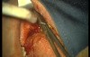 Rebuild Of Madnibular Implant Site (4/4)