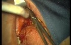 Rebuild Of Madnibular Implant Site (4/4)
