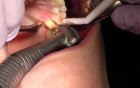 How To Lenghten Clinical Crown? (#14)