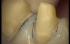 Upper Arch Teeth Preparation And Provisional Crowns (4/5)