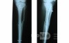 IM Interlocking nail of Tibia