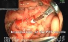 Percutaneous treatment of gastrostomy -EUS