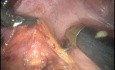 Robotic Total Mesorectal Excision - Marecik Et Al. 