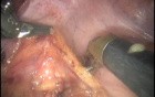 Robotic Total Mesorectal Excision - Marecik Et Al. 
