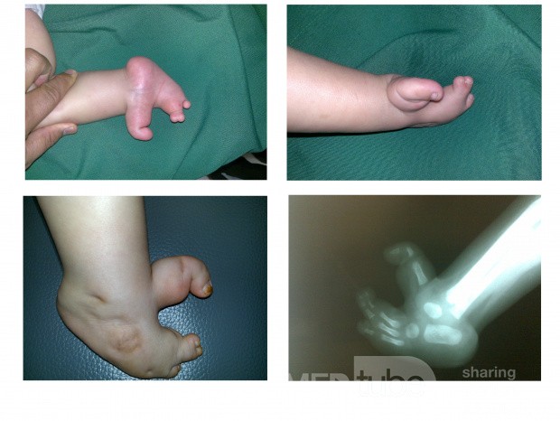 Cleft Foot