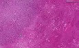 Cirrhosis, hepatocellular carcinoma - Histopathology - Liver