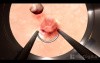Bladder tumor Removal