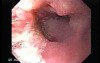 Esophageal Squamous Cell Carcinoma of the the upper third of the Esophagus (1 of 3 )