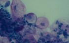 Menopause - Cell degeneration