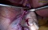 Creation of Tubotubal Anastomosis