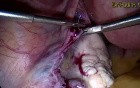 Creation of Tubotubal Anastomosis