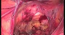 Inguinal Hernioplasty - SILS TAPP 