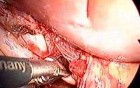 Cholecystectomy - single port access