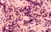 Non-Hodking Lymphoma B Cells. MALT (mucosa associated lymphoid tissue) (6 of 7)