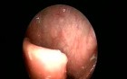 Oral Manifestation Of Aids 