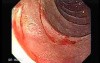 Adenocarcinoma of the Cardias - Closer Look at the Papilla of Vater, Part 2