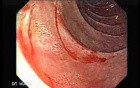Adenocarcinoma of the Cardias - Closer Look at the Papilla of Vater, Part 2