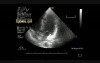Hydatid Cyst In The Interventricular Septum