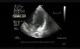 Hydatid Cyst In The Interventricular Septum