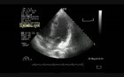 Hydatid Cyst In The Interventricular Septum