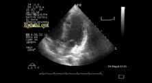 Hydatid Cyst In The Interventricular Septum