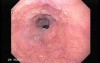 Esophageal Varices and Hiatus Hernia - Presentation of Esophageal Mucosa