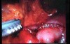 Jejunal Gastrointestinal Stromal tumor (GIST) (82 of 86)