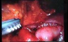 Jejunal Gastrointestinal Stromal tumor (GIST) (82 of 86)