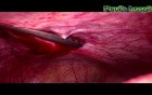 Tracheloplasty