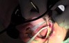 Extraction #18 With Simple Socket Bone Grafting