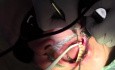 Extraction #18 With Simple Socket Bone Grafting