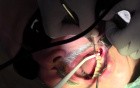 Extraction #18 With Simple Socket Bone Grafting