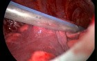 Video-Assisted Thoracoscopic Surgery 4/4