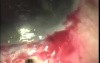 Gaucoma TCF, ABA Surgery with use Fugo Blade and 1-day post-OP