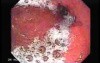 Scirrhous Gastric Carcinoma - Endoscopy (13 of 47)