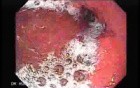 Scirrhous Gastric Carcinoma - Endoscopy (13 of 47)