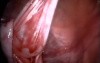 Laparoscopic Cystectomy 