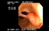 Large Pediculated Polyp - Snare Polypectomy (1 z 5)