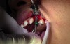 Implant Insertion - Implant Surgery, #11 Site