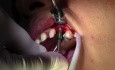 Implant Insertion - Implant Surgery, #11 Site