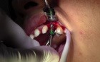 Implant Insertion - Implant Surgery, #11 Site