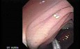 Colonoscopic Polypectomy (10 of 23)