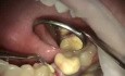 Preparing Bone For Immediate Implantation
