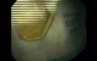 Endoscopic Balloon Removal (9 of 9)